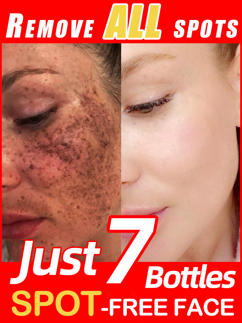 Skincare Luxury Whitening - تفتيح النمش الكلف، البقع الداكنة للوجه